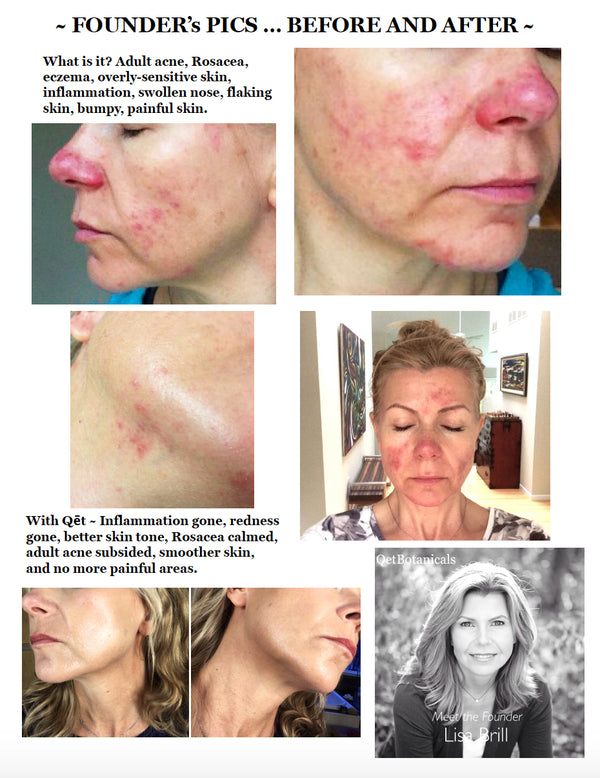 Before & After Photos with Qēt: Acne, Eczema, Rosacea, Wrinkles, Sensitivities
